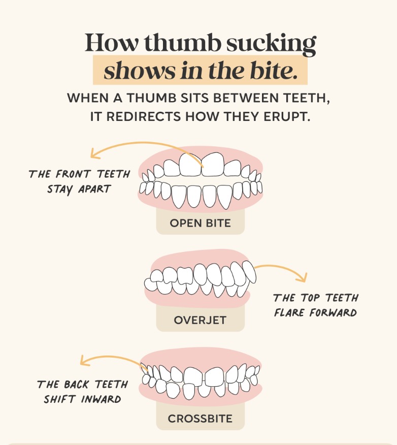 Diagram showing how thumb sucking can shift a child's bite: an open bite with the front teeth apart, an overjet with the top teeth flared forward, and a crossbite with the back teeth shifted inward.